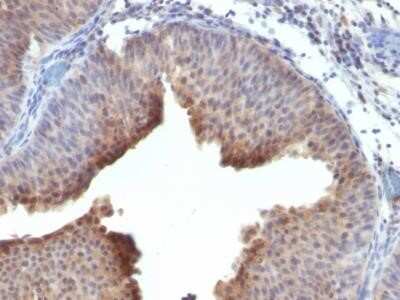 Immunohistochemistry-Paraffin: Cytokeratin 6 Antibody (LHK6 (same as LHK6B)) - Azide and BSA Free [NBP2-34669] - Formalin-fixed, paraffin-embedded human Bladder Carcinoma stained with Cytokeratin 6 Monoclonal Antibody (LHK6).