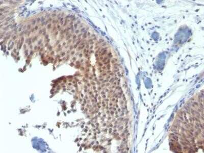 Immunohistochemistry-Paraffin: Cytokeratin 6 Antibody (SPM269) - Azide and BSA Free [NBP2-34406] - Formalin-fixed, paraffin-embedded human Bladder Carcinoma stained with Cytokeratin 6 Monoclonal Antibody (SPM269).