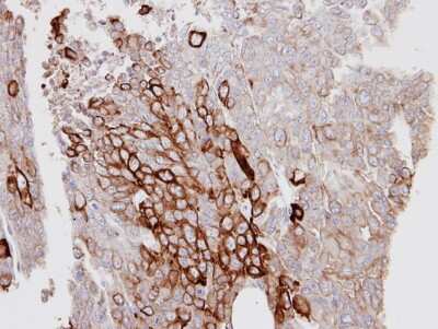 Immunohistochemistry-Paraffin: Cytokeratin 6a Antibody [NBP1-31443] -  D54MG xenograft, using KRT6A antibody at 1:100 dilution. Antigen Retrieval: Trilogy™ (EDTA based, pH 8.0) buffer, 15min.