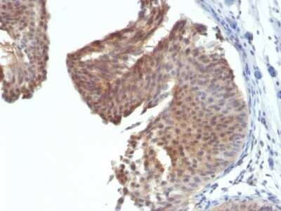 Immunohistochemistry-Paraffin: Cytokeratin 6a Antibody (KRT6/1702) [NBP2-54401] - Formalin-fixed, paraffin-embedded human Bladder Carcinoma stained with Cytokeratin 6 Monoclonal Antibody (KRT6/1702)