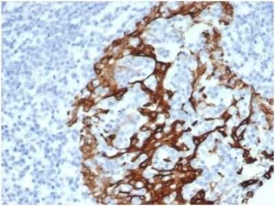 Immunohistochemistry-Paraffin: Cytokeratin 6a Antibody (KRT6/3997R) [NBP3-13955] - Formalin-fixed, paraffin-embedded human prostatestained with Cytokeratin 6a antibody (KRT6/3997R). HIER: Tris/EDTA, pH9.0, 45min. HRP-polymer, 30min. DAB, 5min.