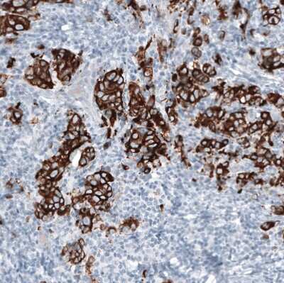 Immunohistochemistry-Paraffin: Cytokeratin 7 Antibody (CL8723) [NBP2-88918] - Staining of human breast cancer shows strong cytoplasmic positivity in tumor cells.