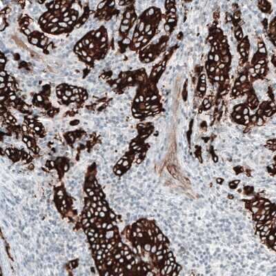 Immunohistochemistry-Paraffin: Cytokeratin 7 Antibody (CL8725) [NBP2-88919] - Staining of human breast cancer shows strong cytoplasmic positivity in tumor cells.