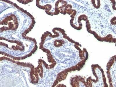 Immunohistochemistry-Paraffin: Cytokeratin 7 Antibody (OV-TL12/30) - IHC-Prediluted [NBP2-48115] - Human Ovarian Carcinoma stained with Cytokeratin 7 Monoclonal Antibody (OV-TL12/30)