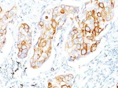 Immunohistochemistry-Paraffin: Cytokeratin 7 Antibody (OV-TL12/30) - IHC-Prediluted [NBP2-48115] - Human Lung SCC stained with Cytokeratin 7 Monoclonal Antibody (OV-TL12/30)