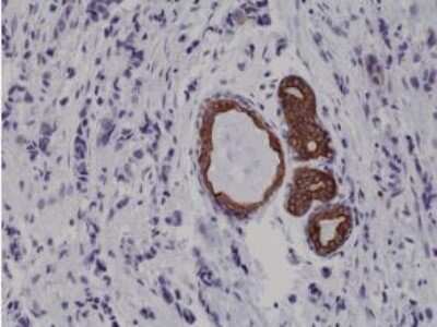 Immunohistochemistry-Paraffin: Cytokeratin 7 Antibody (RM284) [NBP2-61525] - Immunohistochemical staining of formalin fixed and paraffin embedded human breast cancer tissue sections using NBP2-61525.