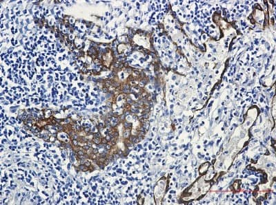 Immunohistochemistry-Paraffin: Cytokeratin 7 Antibody (S03-2E7) [NBP3-19617] - Immunohistochemistry of Cytokeratin 7 in paraffin-embedded Human lung cancer tissue using NBP3-19617 at dilution 1/50