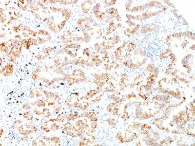 Immunohistochemistry-Paraffin: Cytokeratin 7 Antibody (SPM270) - IHC-Prediluted [NBP2-48124] - Human Lung SCC stained with Cytokeratin 7 Monoclonal Antibody (SPM270).