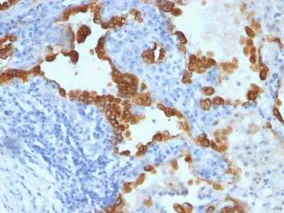 Immunohistochemistry-Paraffin: Cytokeratin 8/18 Antibody (B22.1/B23.1) - IHC-Prediluted [NBP2-48180] - Formalin-fixed, paraffin-embedded human Lung Carcinoma stained with Cytokeratin 8/18 Monoclonal Antibody (B22.1 + B23.1).