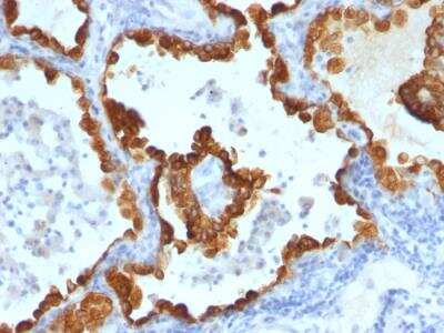 Immunohistochemistry-Paraffin: Cytokeratin 8/18 Antibody (C-43 + DC10) - Azide and BSA Free [NBP2-47982] - Human Lung Carcinoma stained with Cytokeratin 8/18 Monoclonal Antibody (C-43 + DC10).