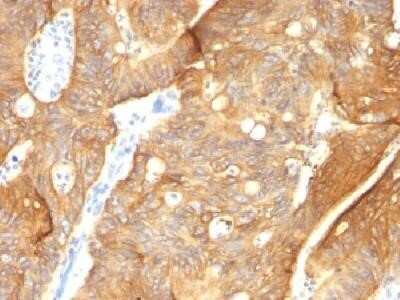 Immunohistochemistry-Paraffin: Cytokeratin 8/18 Antibody (K8.8 + DC10) - Azide and BSA Free [NBP2-34655] - Formalin-fixed paraffin-embedded human colon carcinoma stained with cytokeratin 8/18 Monoclonal Antibody (K8.8 +DC10)
