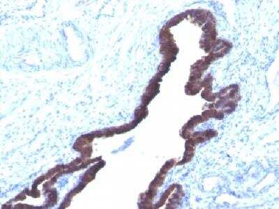 Immunohistochemistry-Paraffin: Cytokeratin 8/18 Antibody (K8.8 + DC10) [NBP2-34344] - Formalin-fixed, paraffin-embedded human Overian cancer stained with Cytokeratin 8/18 Monoclonal Antibody (K8.8 + DC10).