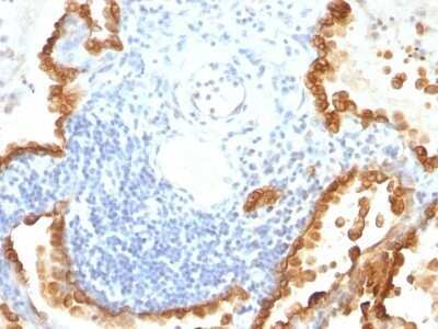 Immunohistochemistry-Paraffin: Cytokeratin 8/18 Antibody (KRT8/803 + KRT18/835) - Azide and BSA Free [NBP2-47983] - Human Lung Carcinoma stained with Cytokeratin 8/18 Monoclonal Antibody (KRT8/803 + KRT18/835).