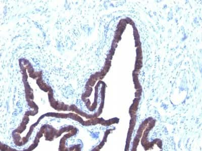 Immunohistochemistry-Paraffin: Cytokeratin 8/18 Antibody (KRT8/803 + KRT18/835) [NBP2-44930] - Human Ovarian Carcinoma stained with Cytokeratin 8/18 Monoclonal Antibody (KRT8/803 + KRT18/835).