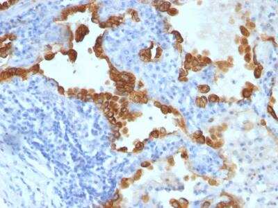 Immunohistochemistry-Paraffin: Cytokeratin 8/18 Antibody (SPM141) - IHC-Prediluted [NBP2-48211] - Formalin-fixed, paraffin-embedded human Lung Carcinoma stained with Cytokeratin 8/18 Monoclonal Antibody (SPM141).