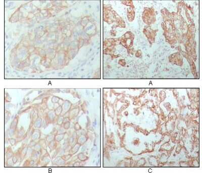 Immunohistochemistry-Paraffin: Cytokeratin 8 Antibody (8A5D12) [NBP1-47533] - Analysis of human breast carcinoma (A), lung cancer (B) and ovarian cancer tissue (C), showing membrane and cytoplasmic localization with DAB staining using CK8 mouse mAb.