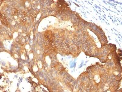 Immunohistochemistry-Paraffin: Cytokeratin 8 Antibody (B22.1) - IHC-Prediluted [NBP2-48146] - Colon Carcinoma stained with Cytokeratin 8 Monoclonal Antibody (B22.1).