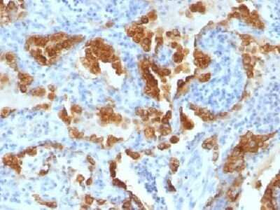 Immunohistochemistry-Paraffin: Cytokeratin 8 Antibody (H1+TS1) - IHC-Prediluted [NBP2-44937] - Formalin-fixed, paraffin-embedded Lung Carcinoma stained with cytokeratin 8 Monoclonal Antibody (H1+TS1).