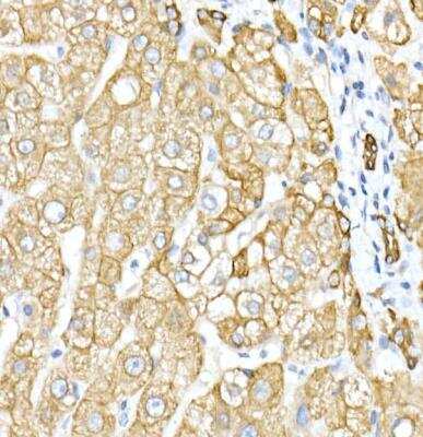 Immunohistochemistry-Paraffin: Cytokeratin 8 Antibody [NBP2-92958] - Human liver using Cytokeratin 8 (KRT8) Rabbit pAb at dilution of 1:50 (40x lens).Perform high pressure antigen retrieval with 10 mM citrate buffer pH 6.0 before commencing with IHC staining protocol.