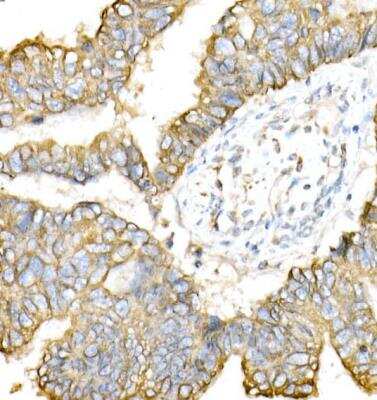 Immunohistochemistry-Paraffin: Cytokeratin 8 Antibody [NBP2-92958] - Human colon carcinoma using Cytokeratin 8 (KRT8) Rabbit pAb at dilution of 1:50 (40x lens).Perform high pressure antigen retrieval with 10 mM citrate buffer pH 6.0 before commencing with IHC staining protocol.