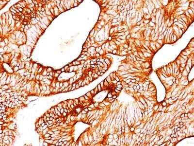 Immunohistochemistry-Paraffin: Cytokeratin 8 Antibody (K8.8) - IHC-Prediluted [NBP2-44939] - Analysis using the Azide and BSA Free version of NBP2-44939. Staining of human colon carcinoma.