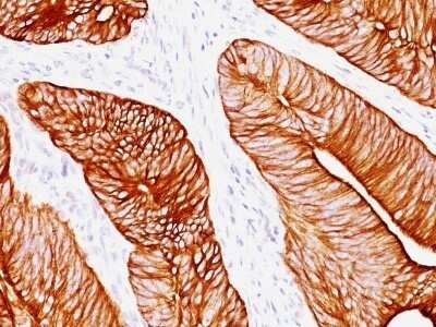 Immunohistochemistry-Paraffin: Cytokeratin 8 Antibody (K8.8) - IHC-Prediluted [NBP2-44939] - Formalin-fixed, paraffin-embedded human Colon Carcinoma stained with Cytokeratin 8 Antibody (K8.8).