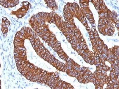 Immunohistochemistry-Paraffin: Cytokeratin 8 Antibody (KRT8.18/1346) [NBP2-54520] - Formalin-fixed, paraffin-embedded human Colon Carcinoma stained with Cytokeratin 8/18 Monoclonal Antibody (KRT8.18/1346).