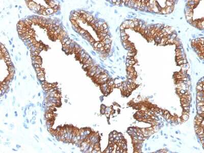 Immunohistochemistry-Paraffin: Cytokeratin 8 Antibody (KRT8.18/1346) [NBP2-54520] - Formalin-fixed, paraffin-embedded human Prostate Carcinoma stained with Cytokeratin 8/18 Monoclonal Antibody (KRT8.18/1346).