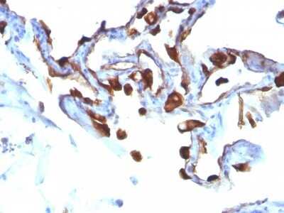 Immunohistochemistry-Paraffin: Cytokeratin 8 Antibody (KRT8/803) [NBP2-44940] - Human Lung Carcinoma stained with Cytokeratin 8 Monoclonal Antibody (KRT8/803).