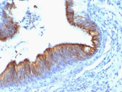 Immunohistochemistry-Paraffin: Cytokeratin 8 Antibody (KRT8/899) [NBP2-44941] - Human Lung Carcinoma stained with Cytokeratin 8 Monoclonal Antibody (KRT8/899).