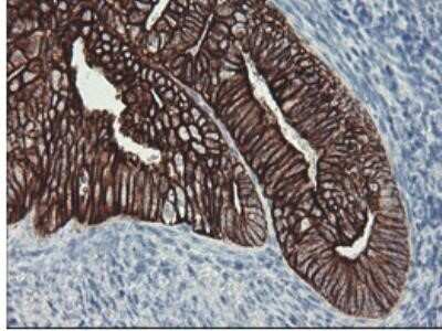 Immunohistochemistry: Cytokeratin 8 Antibody (OTI1B12) - Azide and BSA Free [NBP2-71082] - Staining of paraffin-embedded Adenocarcinoma of Human endometrium tissue using anti-KRT8 mouse monoclonal antibody at 1:150 dilution.