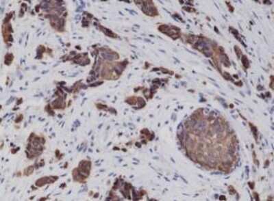 Immunohistochemistry-Paraffin: Cytokeratin 8 Antibody (RM266) [NBP2-61526] - Immunohistochemical staining of formalin fixed and paraffin embedded Human breast cancer tissue sections using NBP2-61526.