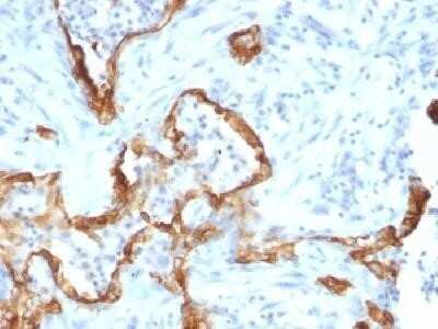 Immunohistochemistry-Paraffin: Cytokeratin 8 Antibody (SPM192) - Azide and BSA Free [NBP2-34400] - Formalin-fixed paraffin-embedded human lung carcinoma stained with cytokeratin monoclonal antibody.