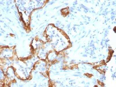 Immunohistochemistry-Paraffin: Cytokeratin 8 Antibody (SPM192) [NBP2-34352] - Formalin-fixed paraffin-embedded human lung carcinoma stained with cytokeratin monoclonal antibody.