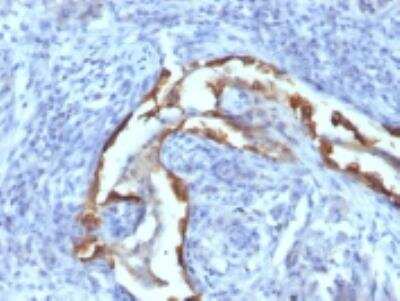Immunohistochemistry-Paraffin: Cytokeratin 8 Antibody (SPM538) [NBP2-34370] - Formalin-fixed, paraffin-embedded human Lung Carcinoma stained  with Cytokeratin 8 Monoclonal Antibody (SPM538).