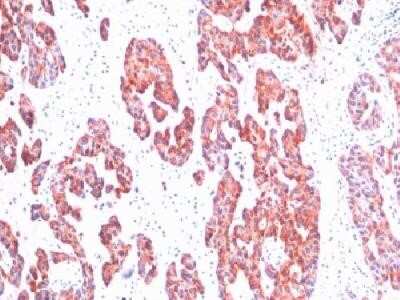 Immunohistochemistry-Paraffin: Cytokeratin, Basic (Type II or HMW) Antibody (SPM116) - Azide and BSA Free [NBP2-34395] - Formalin-fixed, paraffin-embedded human breast carcinoma stained with cytokeratin, HMW Monoclonal Antibody (SPM116)
