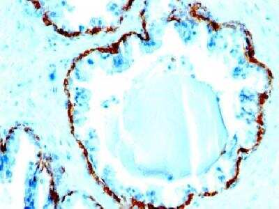 Immunohistochemistry-Paraffin: Cytokeratin, Basic (Type II or HMW) Antibody (SPM591) [NBP2-34388] - Formalin-fixed paraffin-embedded human prostate carcinoma stained with cytokeratin, HMW Monoclonal Antibody (SPM591)