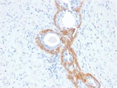 Immunohistochemistry-Paraffin: Cytokeratin, HMW Antibody (rKRTH/2148) - Azide and BSA Free [NBP3-08283] - Formalin-fixed, paraffin-embedded human Prostate Carcinoma stained with Cytokeratin, HMW Mouse Recombinant Monoclonal Antibody (rKRTH/2148).