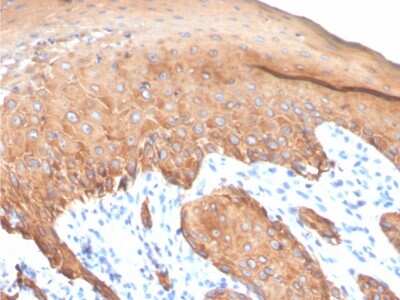 Immunohistochemistry-Paraffin: Cytokeratin, LMW Antibody (KRTL/4440R) - Azide and BSA Free [NBP3-08422] - Formalin-fixed, paraffin-embedded human colon carcinoma stained with Cytokeratin, LMW Recombinant Rabbit Monoclonal Antibody (KRTL/4440R).