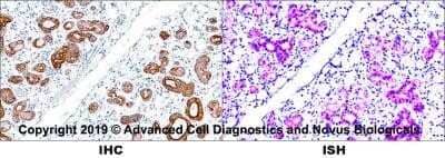 Formalin-fixed paraffin-embedded tissue sections of human metastatic tonsil were probed for Pan Cytokeratin mRNA (ACD RNAScope probe, catalog # 310221; Fast Red chromogen, ACD catalog # 322500). Adjacent tissue section was processes for immunohistochemistry using mouse monoclonal  (Novus catalog # NBP2-29429) at 0.3ug/mL for 1 hour at room temperature followed by incubation with the anti-mouse IgG VisUCyte HRP Polymer Antibody (Catalog # VC001) and DAB chromogen (yellow-brown). Tissue was counterstained with hematoxylin (blue).