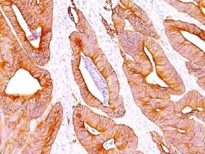 Analysis of Human Colon Carcinoma stained with pan Cytokeratin Monoclonal Antibody cocktail (AE-1/AE3).