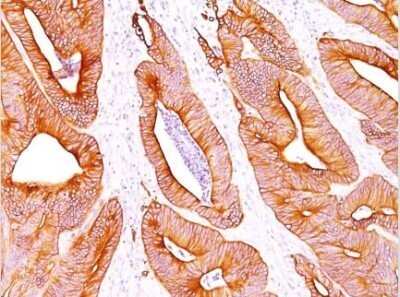 Analysis using Azide and BSA Free version of NBP2-48225. Human Colon Carcinoma stained with pan Cytokeratin Monoclonal Antibody cocktail (AE-1/AE3).