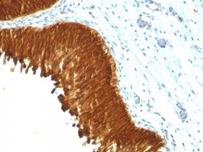 Immunohistochemistry-Paraffin: Cytokeratin, pan Antibody (KRT/457) - Azide and BSA Free [NBP2-47669] - Human Bladder Carcinoma stained with Multi Cytokeratin Monoclonal Antibody (KRT/457).