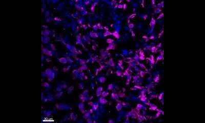 Immunohistochemistry-Frozen: Cytokeratin, pan Antibody (PAN-CK (Cocktail)) - Azide and BSA Free [NBP2-76425] - Human breast cancer tissue stained for panCK (purple) and counterstained with DAPI (blue). The Alexa Fluor 750 conjugate of this antibody was used. IHC-Fr image submitted by a verified customer review.