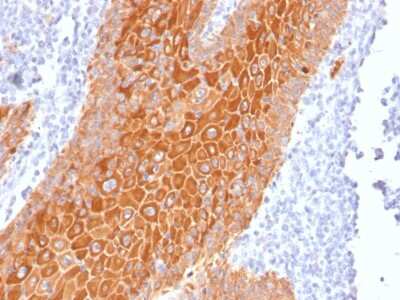 Immunohistochemistry-Paraffin: Cytokeratin, pan Antibody (PAN-CK (Cocktail)) - Azide and BSA Free [NBP2-76425] - Formalin-fixed, paraffin-embedded human squamous cell carcinoma stained with Cytokeratin, pan Mouse Monoclonal Antibody (PAN-CK).