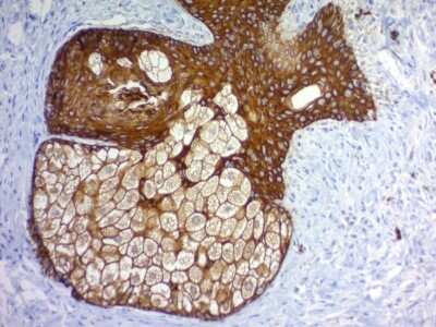 Immunohistochemistry-Paraffin: Cytokeratin, pan Antibody (PAN-CK (Cocktail)) - IHC-Prediluted [NBP2-48300] - Formalin-fixed, paraffin-embedded human basal cell carcinoma stained with Cytokeratin, pan Mouse Monoclonal Antibody (PAN-CK).