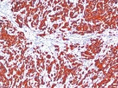 Immunohistochemistry-Paraffin: Cytokeratin, pan Antibody (SPM115 + SPM116) - IHC-Prediluted [NBP2-44370] - FFPE human breast carcinoma stained with pan cytokeratin monoclonal antibody cocktail (SPM115+SPM116).