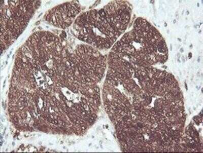 Immunohistochemistry: Cytosol Nonspecific Dipeptidase (CNDP2)/CPGL Antibody (OTI8A2) - Azide and BSA Free [NBP2-72019] - Staining of paraffin-embedded Adenocarcinoma of Human ovary tissue using anti-CNDP2 mouse monoclonal antibody.