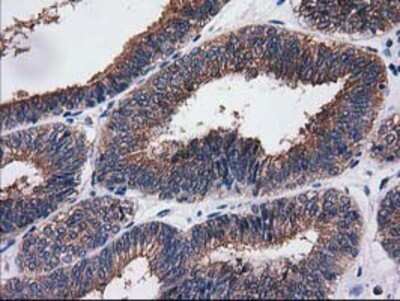 Immunohistochemistry: Cytosolic Sulfotransferase 1C2/SULT1C2 Antibody (OTI4G1) - Azide and BSA Free [NBP2-71313] - Staining of paraffin-embedded Adenocarcinoma of Human endometrium tissue using anti-SULT1C2 mouse monoclonal antibody.