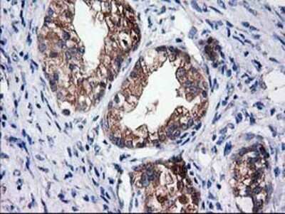 Immunohistochemistry: Cytosolic Sulfotransferase 1C2/SULT1C2 Antibody (OTI4G1) - Azide and BSA Free [NBP2-71313] - Staining of paraffin-embedded Adenocarcinoma of Human ovary tissue using anti-SULT1C2 mouse monoclonal antibody.